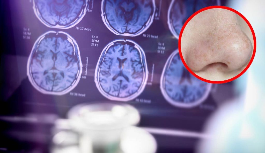 Naso e Alzheimer